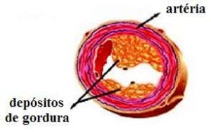 Causas, sintomas, tratamento e prevenção da aterosclerose.