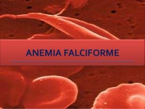 Anemia Falciforme (Foto:Reprodução) Créditos de imagem:http://pt.slideshare.net/