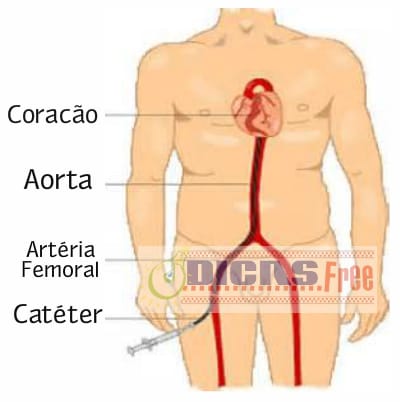 O procedimento é capaz de avistar toda a corrente sanguínea