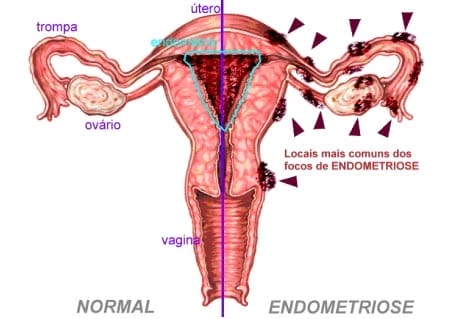 A endometriose é uma doença que causa desconforto na região pélvica. 