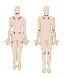 Pontos sensíveis da fibromialgia marcados em pontos na cor roxa