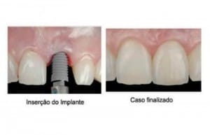 Implante dentário