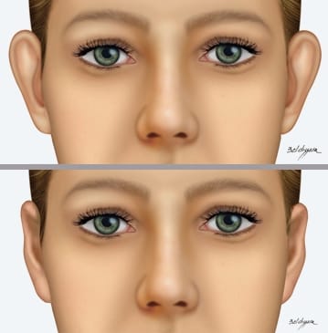 A otoplastia é um procedimento cirúrgico capaz de consertar as orelhas de abano