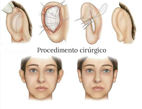 Otoplastia é um procedimento cirúrgico para correção das orelhas de abano