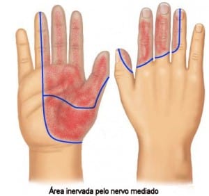 Síndrome de carpo é uma doença que afeta desde os dedos das mãos, até os punhos. 