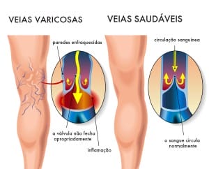 Varizes - entenda mais sobre elas (Foto: Divulgação)