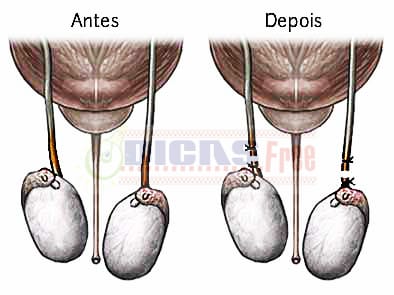 O processo cirúrgico tem como finalidade cortar o canal reprodutor do homem